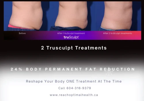 Male Body Sculpting with True Body Treatment