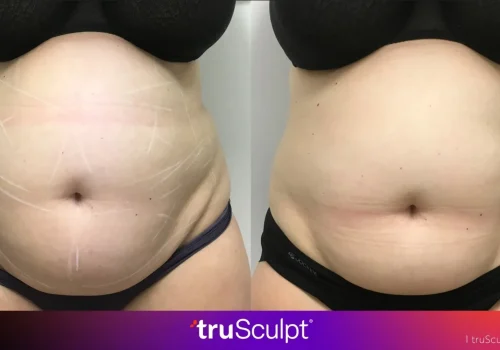 tru body sculpting treatment for Woman
